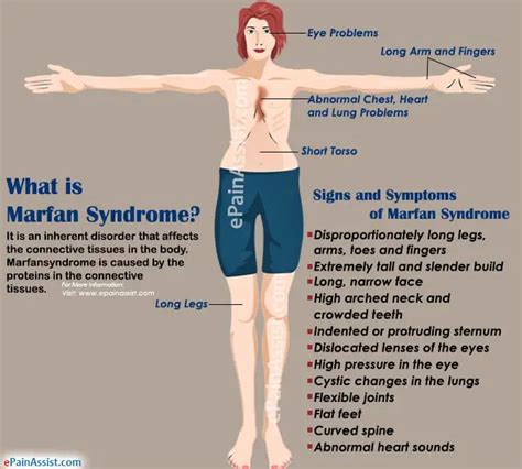 syndrome de marfan -- photo|what is marfan syndrome disease.